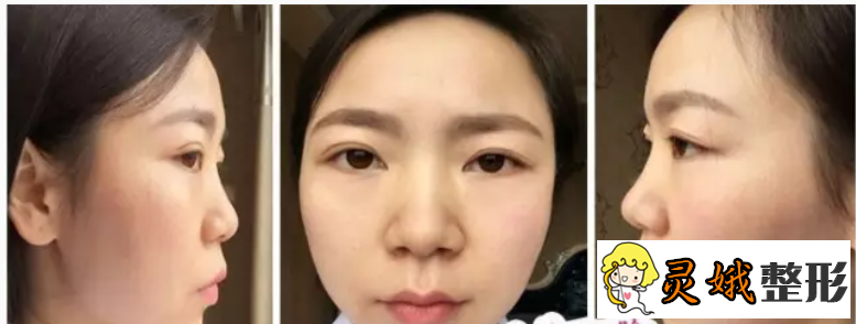 韩式翘睫双眼皮的做法之韩式翘睫双眼皮优势