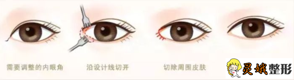 北京双眼皮多少钱之双眼皮手术术后护理