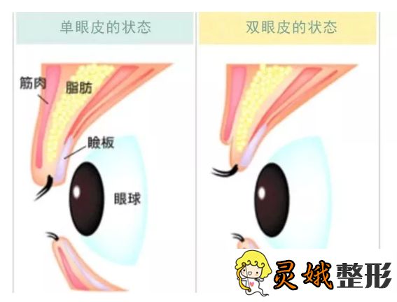 北京割双眼皮费用之割双眼皮术后注意事项
