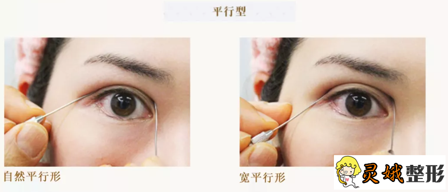 北京割双眼皮费用之割双眼皮术后注意事项