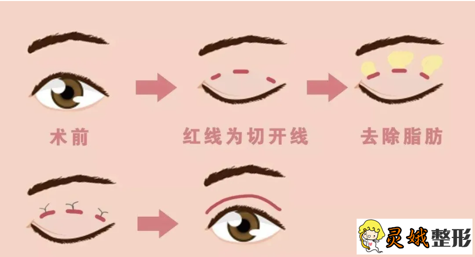 北京做双眼皮之双眼皮失败的修复方法,不同的问题有不同的修复方法