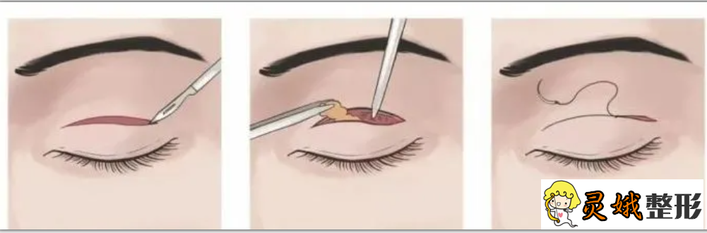 双眼皮埋线法的原理果技术科普，如何get美丽大眼睛~