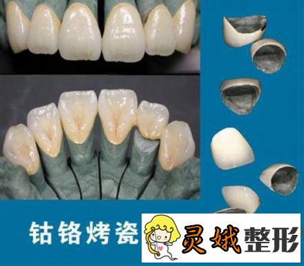 钴铬烤瓷牙的寿命以及术后注意事项，让牙齿更健康！