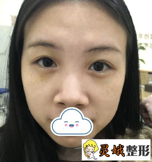 王文娟医生怎么样？打造优质韩式小翘鼻，让鼻子更漂亮！