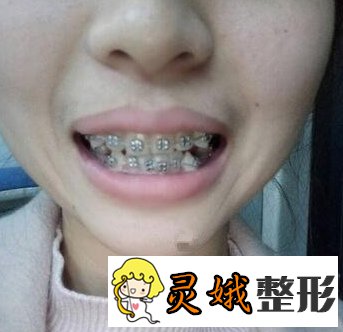 为什么北京叶子整形医院深受欢迎？快来看看牙齿矫正案例吧！