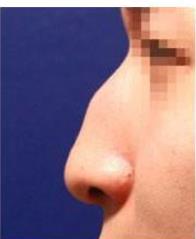 驼峰鼻手术应该注意什么