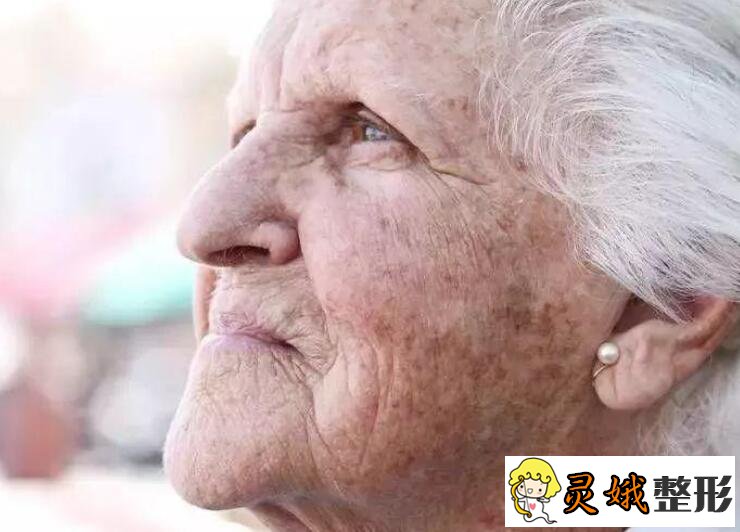 如何预防老年斑的形成