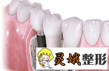 种植牙齿常见问题