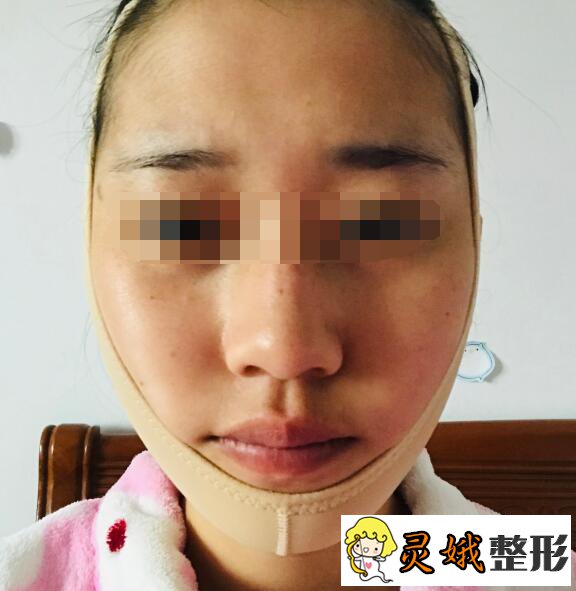 广州韩致整形医院下颌角整形手术后一周