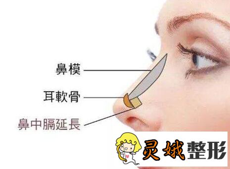 固体硅胶隆鼻的优势特点