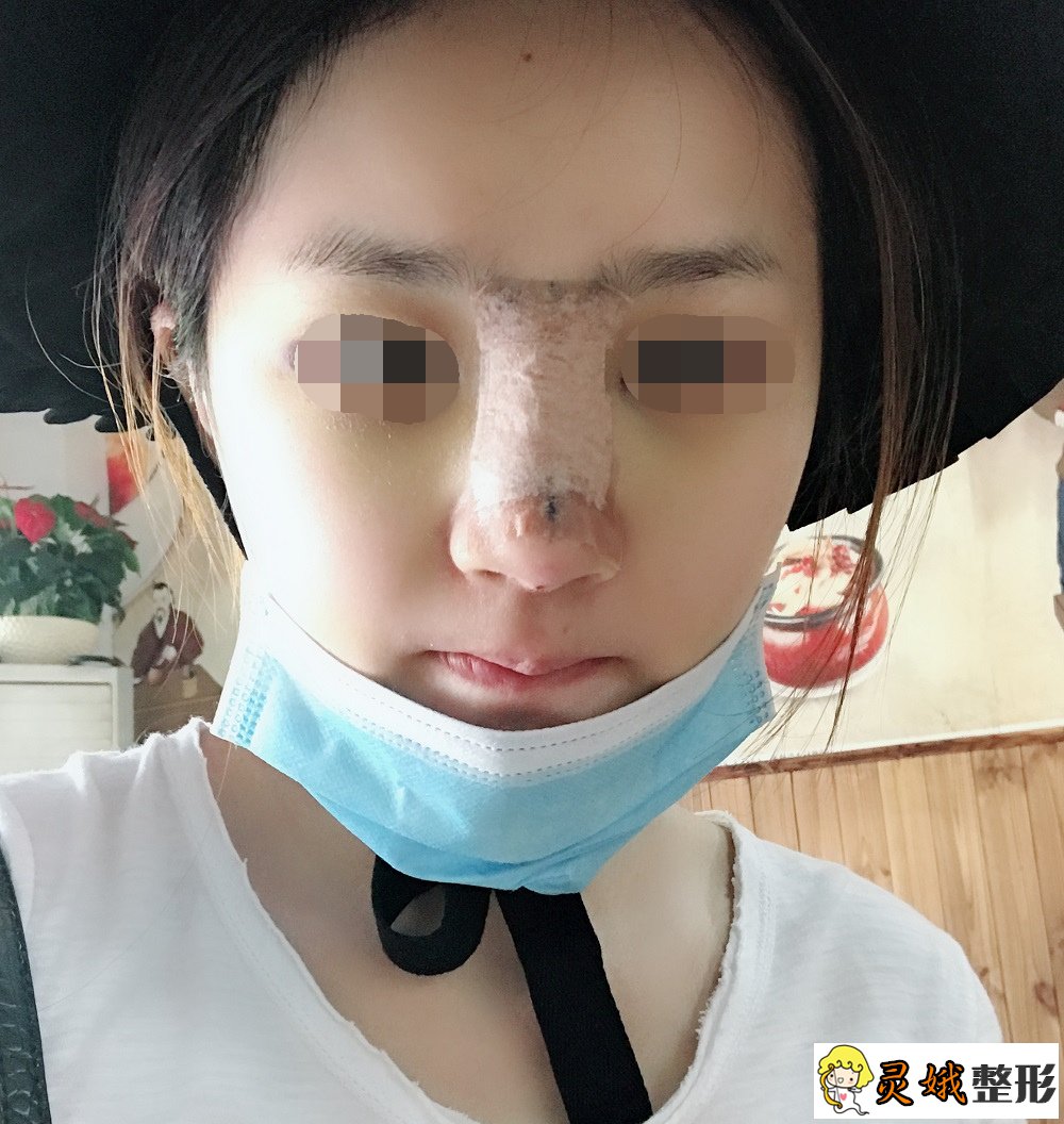 巫文云医生是怎样用肋软骨隆鼻进行鼻部手术手术的？