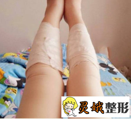 陈光平医生 无锡丽都(原瑞丽)整形，瘦小腿的季节到了！