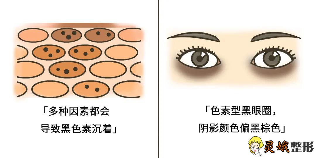 黑眼圈严重是身体上什么原因引起的?应该怎么解决？