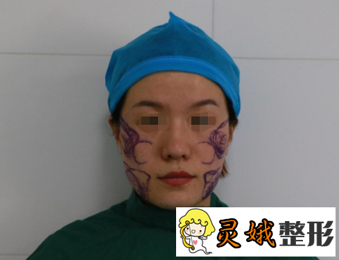 青海省人民医院整形美容科,这里做的瘦脸项目怎么样呢？