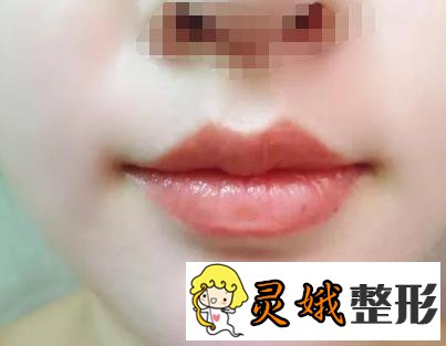 唇部整形有哪些方式？常见的美唇方法来了解一下叭！