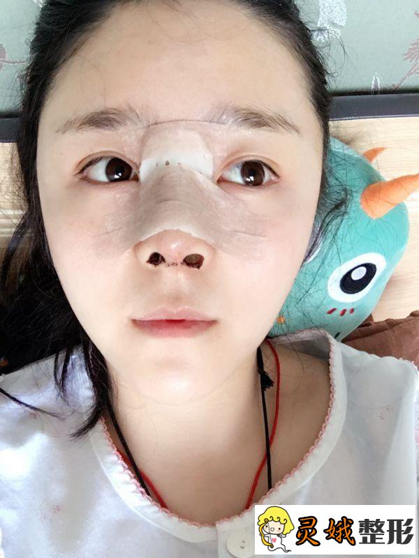 许昌市立医院整形隆鼻案例：术后应该怎么恢复