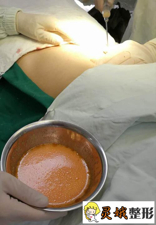 沧州中心医院整形美容科腹部抽脂案例