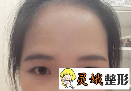 潍坊人民医院美容整形科双眼皮案例