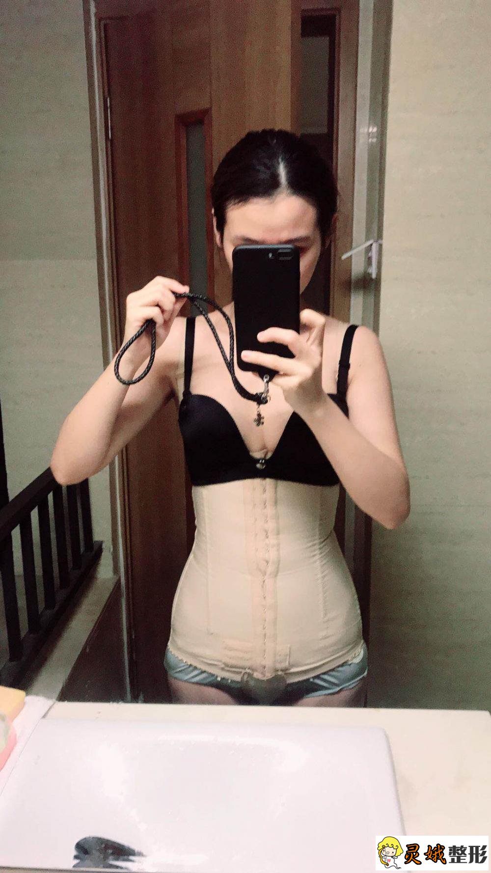桂林医学院附属整形医院腹部抽脂案例