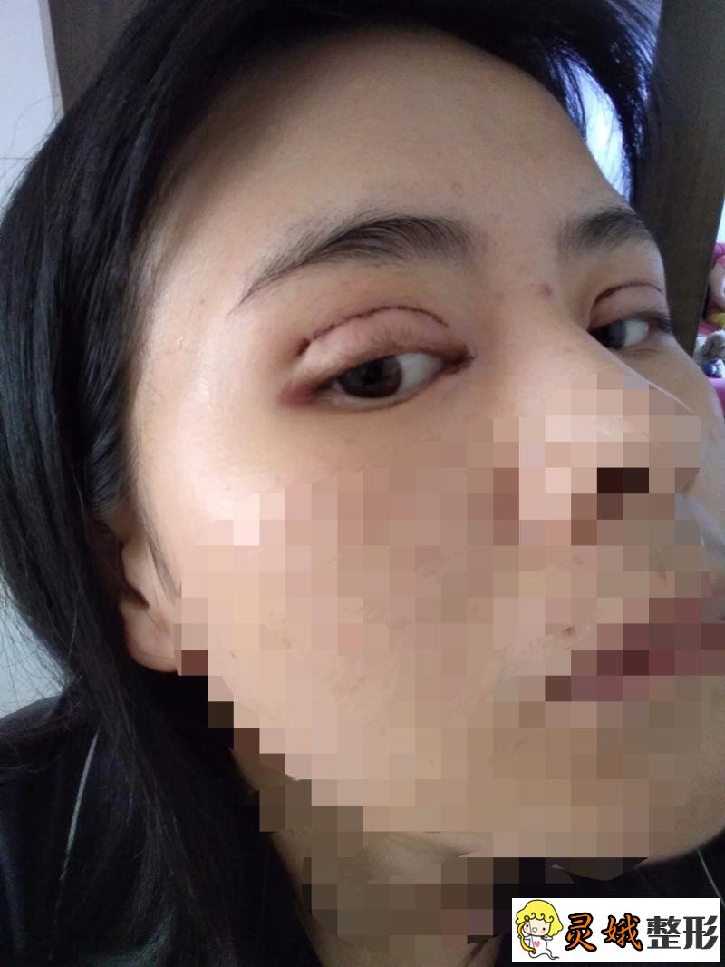 秦皇岛人民医院美容科双眼皮修复案例