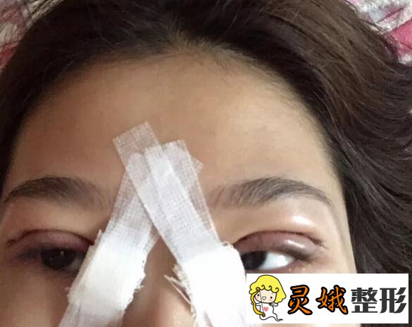 秦皇岛人民医院美容科双眼皮修复案例