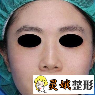 贵阳市第一人民医院整形烧伤科激光祛斑案例