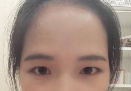 青海省人民医院整形外科怎么样？双眼皮案例
