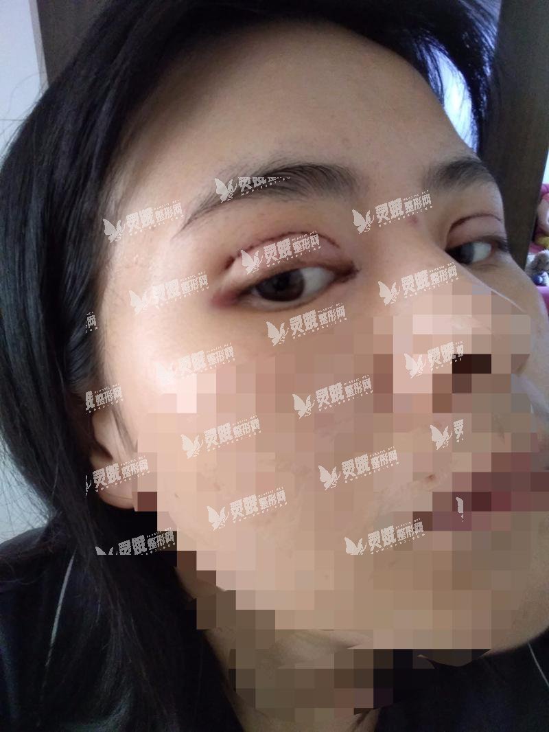 秦皇岛人民医院美容科怎么样?双眼皮修复案例