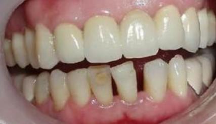 黔南州人民医院口腔科的实力怎么样?牙齿修复案例