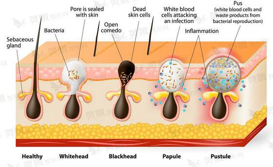 果酸换肤就是通过酸类成分来加快角质细胞和表皮细胞的更新速度