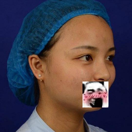 郴州人民医院整形科隆鼻手术案例