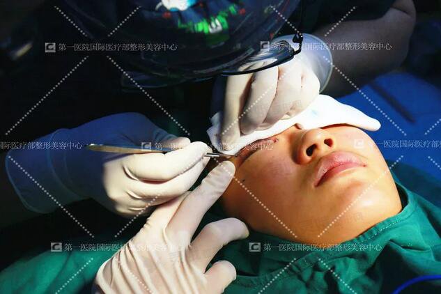 进口光子刀用于手术，了双眼皮，流畅的线条准确的剥离了保存下来的血管网