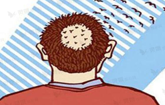 调节斑秃较为科学的方法