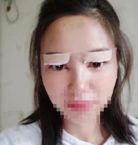 杨明峰医生整形双眼皮案例反馈图