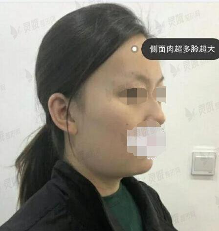 北京301医院整形外科面部吸脂果图