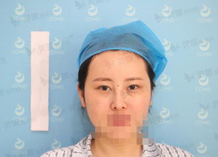 中山人民医院整形科割双眼皮案例