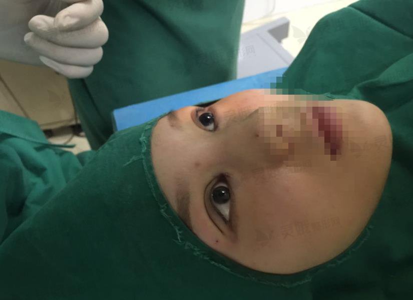 【案例】王海平眼睛修复手术怎么样？做双眼皮真的要“对症下药”！