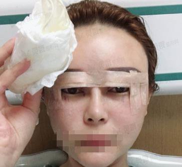 西京医院夏文森修复双眼皮怎么样？案例2021近期更新