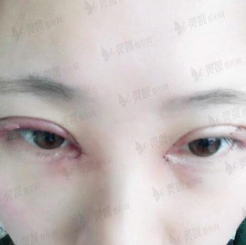 冯晓玲医生双眼皮修复案例展示