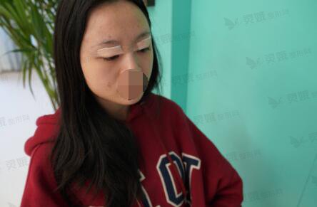 肇庆第一人民医院整形外科割双眼皮后