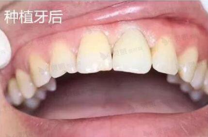 黔南州人民医院口腔科种植牙后