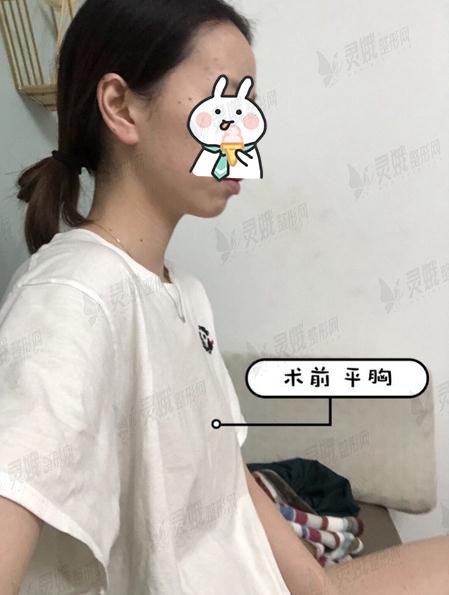 北京301整形修复科假体隆胸案例