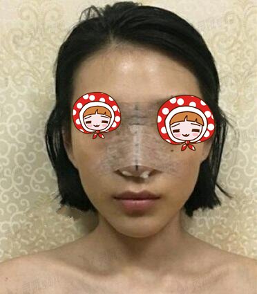 四川省人民医院整形外科隆鼻案例