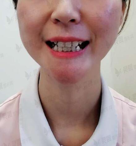 张宇医生成功牙齿矫正后半年
