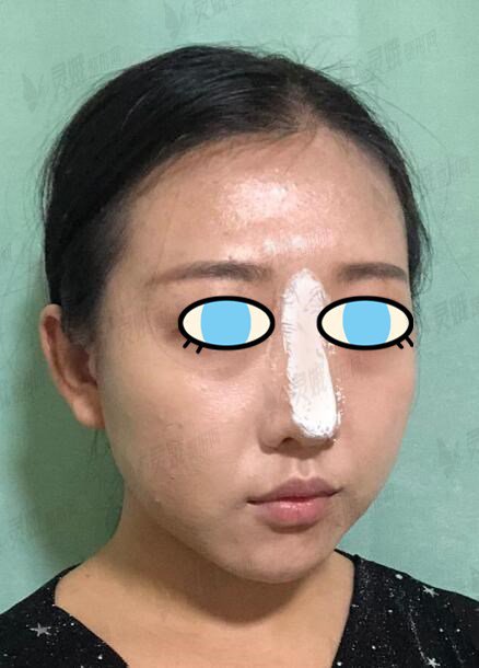 金长鑫做鼻子手术过程