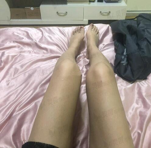 深圳颜美医疗美容整形门诊部大腿抽脂案例