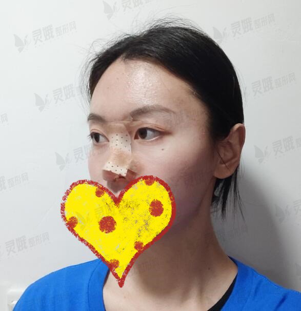 武汉协和医院钟爱梅鼻部手术手术过程