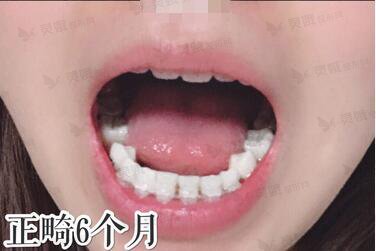 上海圣贝口腔宋桂玲医生牙齿正畸案例