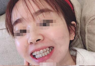 上海圣贝口腔宋桂玲医生牙齿正畸案例