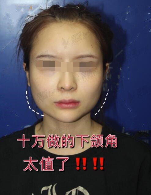 武汉协和医院李小丹教授下颌角整形术前